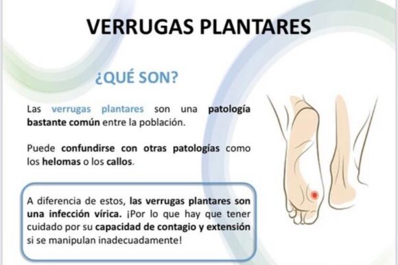 Qué son las verrugas plantares y cómo tratarlas Clínica Fivasa