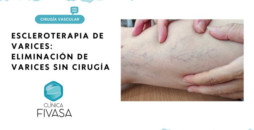 Escleroterapia de varices: eliminación de varices sin cirugía